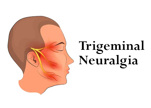 Trigeminal Neuralgia